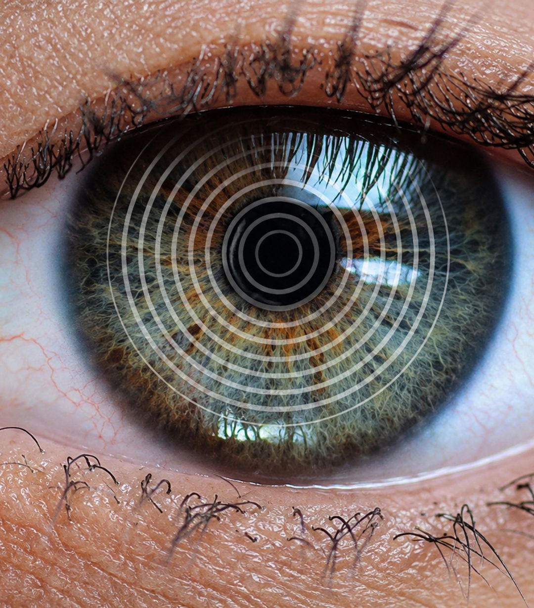 Dry eye image with placido ring