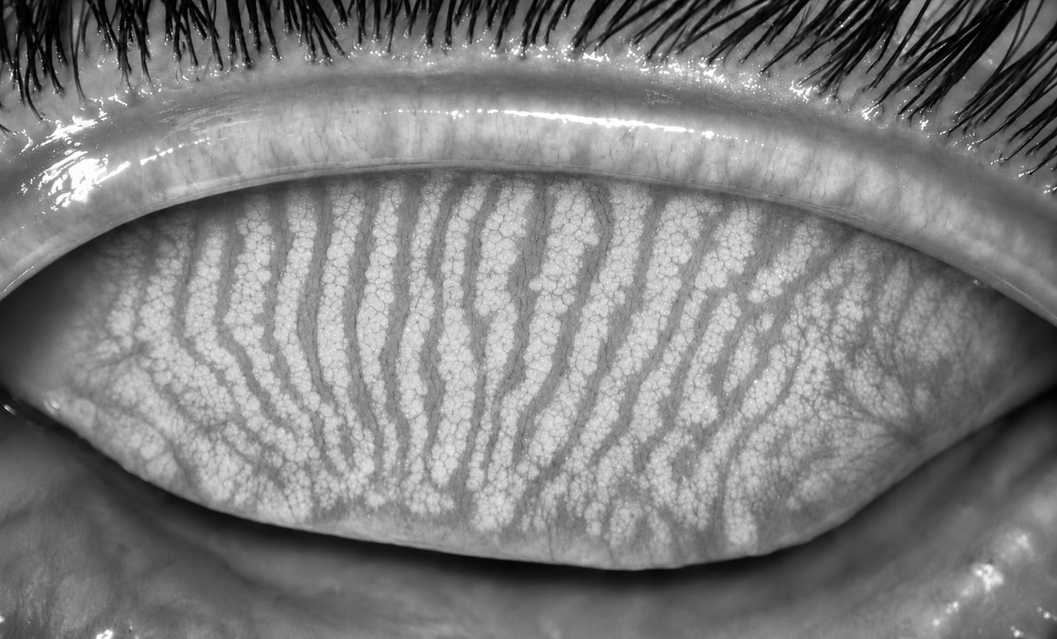 Meibography Image Upper Eyelid