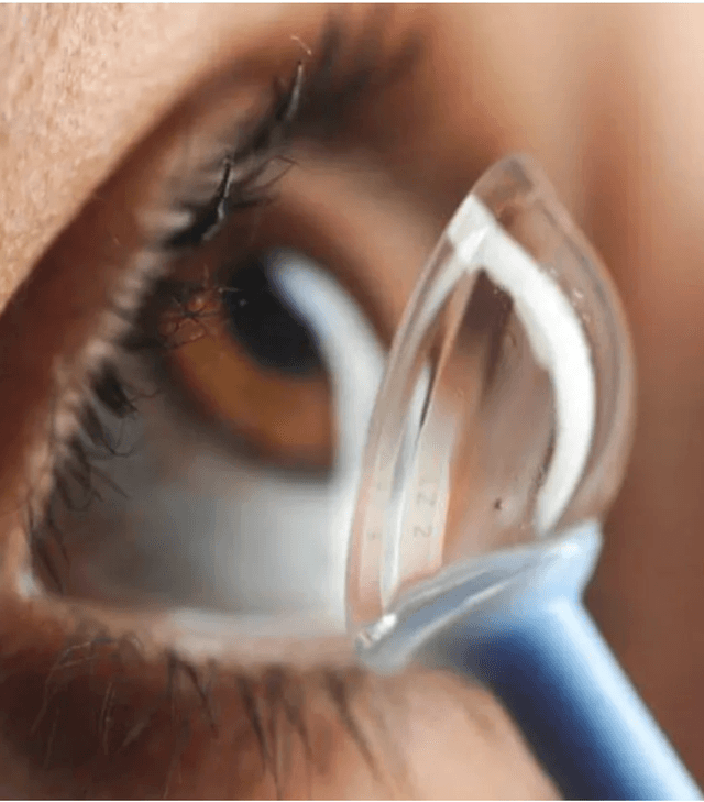 Close-up of contact lens scleral lens insertion during specialist contact lens fitting consultation